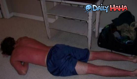 Awful Sunburn Legs