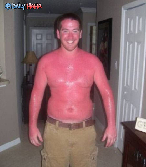 Very Red Sunburn