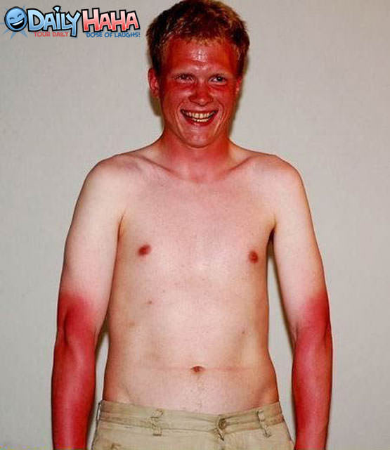 Horrible Sun Burn Picture