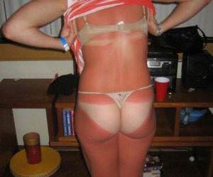 Insane Sunburn Girl funny picture