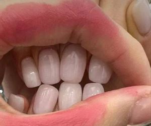 new teeth