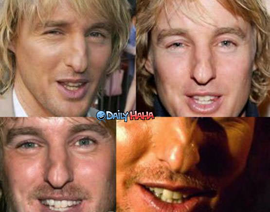 Owen Wilsons Nose