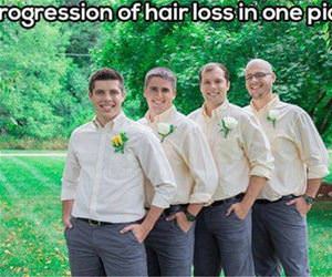 progression of hair loss funny picture