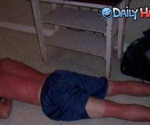 Awful Sunburn Legs