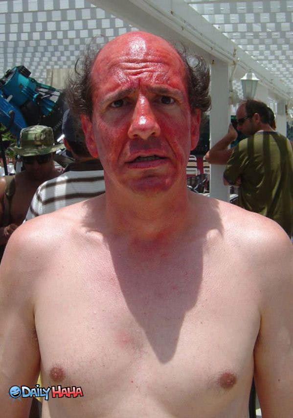 Some Major Sunburn PIc