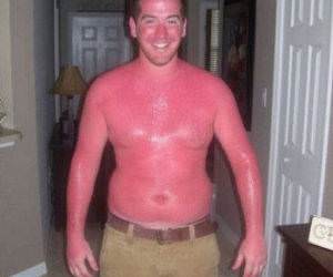 Very Red Sunburn