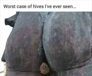 worst case of hives